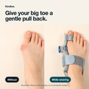 Foot with a bunion without the brace, and the same foot while wearing the Kindtoe Dial